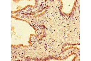 Immunohistochemistry of paraffin-embedded human prostate cancer using ABIN7165948 at dilution of 1:100 (PPM1H 抗体  (AA 73-289))