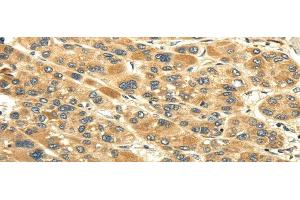 Immunohistochemistry of paraffin-embedded Human liver cancer tissue using UACA Polyclonal Antibody at dilution 1:45 (UACA 抗体)