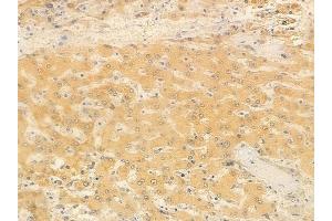 ABIN6260215 and ABIN6266858 at 1/100 staining human hepatocellular carcinoma by IHC-P. (BCAR3 抗体  (C-Term))