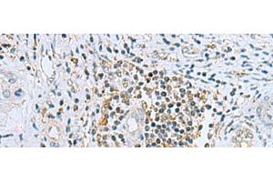 Immunohistochemistry of paraffin-embedded Human liver cancer tissue using DHRS7B Polyclonal Antibody at dilution of 1:80(x200) (DHRS7B 抗体)