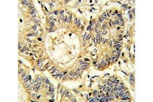 IHC analysis of FFPE human colon carcinoma stained with SOCS1 antibody
