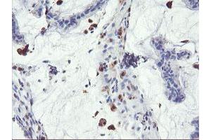 Immunohistochemical staining of paraffin-embedded Adenocarcinoma of Human colon tissue using anti-SDS mouse monoclonal antibody. (serine Dehydratase 抗体)