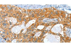 Immunohistochemistry of paraffin-embedded Human cervical cancer tissue using AMHR2 Polyclonal Antibody at dilution 1:40