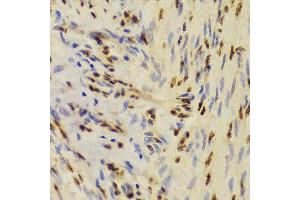 Immunohistochemistry of paraffin-embedded Human adenomyosis using XRCC5 antibody at dilution of 1:100 (40x lens). (XRCC5 抗体)