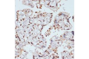 Immunohistochemistry of paraffin-embedded human placenta using Phospho-Chk1-S280 antibody (ABIN3019445, ABIN3019446, ABIN3019447 and ABIN6225372) at dilution of 1:100 (40x lens). (CHEK1 抗体  (pSer280))