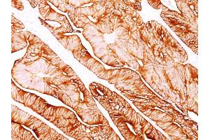 Formalin-fixed, paraffin-embedded human Colon Carcinoma stained with Cytokeratin 8 Mouse Monoclonal Antibody (H1). (KRT8 抗体)