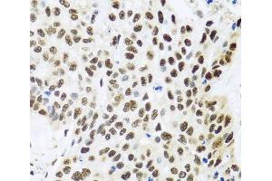 Immunohistochemistry of paraffin-embedded Human lung cancer using FUBP1 Polyclonal Antibody at dilution of 1:100 (40x lens). (FUBP1 抗体)