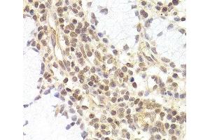 Immunohistochemistry of paraffin-embedded Human adenomyosis using PHC1 Polyclonal Antibody at dilution of 1:200 (40x lens). (PHC1 抗体)