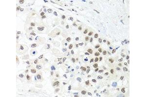Immunohistochemistry of paraffin-embedded Human lung cancer using TRMT1 Polyclonal Antibody at dilution of 1:100 (40x lens). (TRMT1 抗体)
