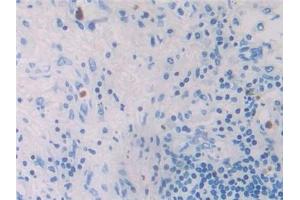 Detection of MIP4a in Human Lung cancer Tissue using Polyclonal Antibody to Macrophage Inflammatory Protein 4 Alpha (MIP4a) (CCL26 抗体  (AA 24-94))