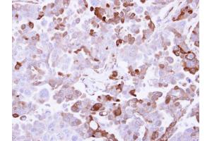 IHC-P Image Immunohistochemical analysis of paraffin-embedded OVCAR3 xenograft, using AKR1B10, antibody at 1:500 dilution. (AKR1B10 抗体)
