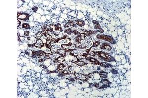 TGFB2 antibody immunohistochemistry analysis in formalin fixed and paraffin embedded human colon carcinoma