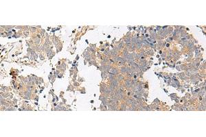 Immunohistochemistry of paraffin-embedded Human lung cancer tissue using GPR153 Polyclonal Antibody at dilution of 1:40(x200) (GPR153 抗体)