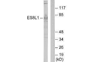 Immunohistochemistry analysis of paraffin-embedded human colon carcinoma tissue using ES8L1 antibody. (EPS8-Like 1 抗体)