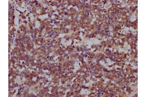 IHC image of ABIN7168099 diluted at 1:200 and staining in paraffin-embedded human lung cancer performed on a Leica BondTM system. (DROSHA 抗体  (AA 1-100))