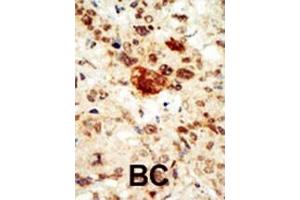 Formalin-fixed and paraffin-embedded human cancer tissue reacted with the primary antibody, which was peroxidase-conjugated to the secondary antibody, followed by AEC staining. (EPHA1 抗体  (C-Term))