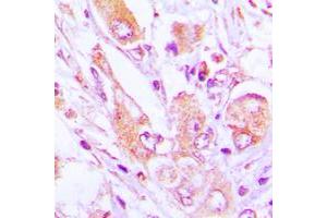 Immunohistochemical analysis of MRPS35 staining in human lung cancer formalin fixed paraffin embedded tissue section. (MRPS35 抗体  (Center))
