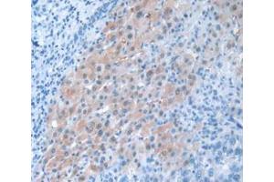 IHC-P analysis of Human Liver Cancer Tissue, with DAB staining. (PANX1 抗体  (AA 228-411))