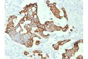 Formalin-fixed, paraffin-embedded human Colon Carcinoma stained with Cytokeratin 20 (KRT20) Mouse Monoclonal Antibody (KRT20/1992). (KRT20 抗体  (AA 196-323))