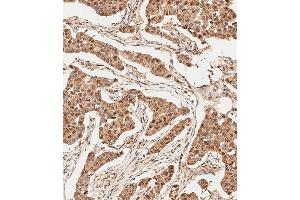 Immunohistochemical analysis of paraffin-embedded Human breast carcinoma tissue using (ABIN388039 and ABIN2845540) performed on the Leica® BOND RXm. (Ubiquitin 抗体  (N-Term))