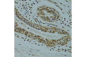 Immunohistochemistry of paraffin-embedded human breast cancer using RSRC1 antibody (ABIN5974341) at dilution of 1/100 (40x lens). (RSRC1 抗体)