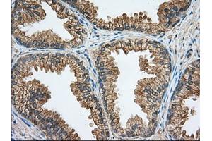 Immunohistochemical staining of paraffin-embedded Carcinoma of Human liver tissue using anti-RAB17 mouse monoclonal antibody. (RAB17 抗体)