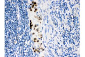 Cardiac FABP was detected in paraffin-embedded sections of human intestinal cancer tissues using rabbit anti- Cardiac FABP Antigen Affinity purified polyclonal antibody (Catalog # ) at 1 ?