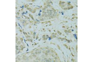 Immunohistochemistry of paraffin-embedded human breast cancer using SAFB antibody (ABIN5975793) at dilution of 1/100 (40x lens). (SAFB 抗体)