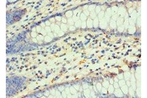 Immunohistochemistry of paraffin-embedded human colon cancer using ABIN7155678 at dilution of 1:100 (DLX3 抗体  (AA 1-120))