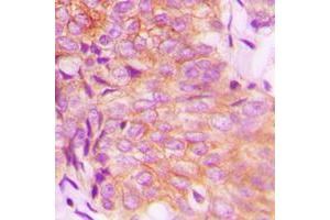 Immunohistochemical analysis of EPS8L3 staining in human breast cancer formalin fixed paraffin embedded tissue section.