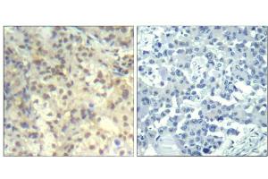 Immunohistochemical analysis of paraffin-embedded human lung carcinoma tissue using cofilin1 (phospho-Tyr139) Antibody (E011506). (Cofilin 抗体  (pTyr139))