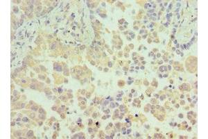 Immunohistochemistry of paraffin-embedded human lung cancer using ABIN7154967 at dilution of 1:100 (N6AMT1 抗体  (AA 1-186))