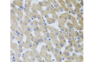 Immunohistochemistry of paraffin-embedded Human liver damage using UVRAG Polyclonal Antibody at dilution of 1:100 (40x lens). (UVRAG 抗体)