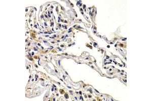 Immunohistochemistry of paraffin-embedded human lung cancer using WNT3A antibody at dilution of 1:200 (400x lens). (WNT3A 抗体)
