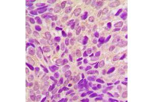 Immunohistochemical analysis of RSK4 staining in human breast cancer formalin fixed paraffin embedded tissue section. (RPS6KA6 抗体  (C-Term))