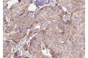 ABIN6272946 at 1/100 staining Human breast cancer tissue by IHC-P. (PPFIA1 抗体  (C-Term))