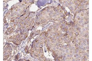 ABIN6272946 at 1/100 staining Human breast cancer tissue by IHC-P. (PPFIA1 抗体  (C-Term))