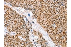The image on the left is immunohistochemistry of paraffin-embedded Human lung cancer tissue using ABIN7129916(IRF6 Antibody) at dilution 1/50, on the right is treated with fusion protein. (IRF6 抗体)