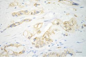 Immunohistochemistry was performed on paraffin-embedded human pancreatic adenocarcinoma using sonic hedgehog antibody (ABIN7800969), 1:200). (Recombinant Sonic Hedgehog Signaling Molecule 抗体)