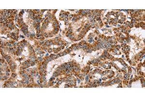 Immunohistochemistry of paraffin-embedded Human thyroid cancer using PPOX Polyclonal Antibody at dilution of 1:40 (PPOX 抗体)