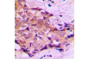 Immunohistochemical analysis of DNAL4 staining in human breast cancer formalin fixed paraffin embedded tissue section. (DNAL4 抗体  (N-Term))