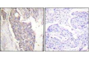 Immunohistochemistry analysis of paraffin-embedded human breast carcinoma tissue using Fas antibody.
