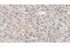 Immunohistochemistry of paraffin-embedded Human liver cancer using SLIT2 Polyclonal Antibody at dilution of 1:30 (SLIT2 抗体)