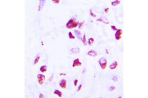Immunohistochemical analysis of C/EBP delta/epsilon staining in human lung cancer formalin fixed paraffin embedded tissue section. (C/EBP delta/epsilon (C-Term) 抗体)