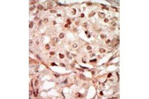 Formalin-fixed and paraffin-embedded human cancer tissue reacted with the primary antibody, which was peroxidase-conjugated to the secondary antibody, followed by DAB staining. (CDK10 抗体  (N-Term))