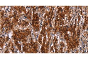 Immunohistochemistry of paraffin-embedded Human gastric cancer tissue using GCKR Polyclonal Antibody at dilution 1:50 (GCKR 抗体)