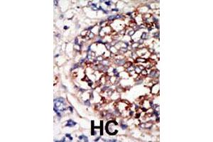 Formalin-fixed and paraffin-embedded human hepatocellular carcinoma tissue reacted with DYRK1B polyclonal antibody  , which was peroxidase-conjugated to the secondary antibody, followed by DAB staining. (DYRK1B 抗体  (C-Term))