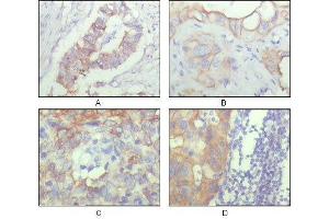 Immunohistochemical analysis of paraffin-embedded human ovary carcinoma (A), kidney carcinoma (B), lung carcinoma (C) and breast carcinoma (D), showing cytoplasmic and membrane localization with DAB staining using ALCAM mouse mAb.
