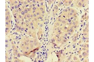Immunohistochemistry of paraffin-embedded human liver cancer using ABIN7144950 at dilution of 1:100 (PFKL 抗体  (AA 229-479))