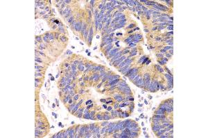 Immunohistochemistry of paraffin-embedded human colon carcinoma using HMGCL antibody (ABIN5975709) at dilution of 1/100 (40x lens). (HMGCL 抗体)